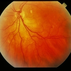 Heme Exudate Ischemia From Multiple Myeloma - Retina Image Bank