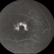 Pattern Dystrophy Pattern Dystrophy