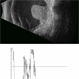 Vasoproliferative Tumor Vasoproliferative Tumor