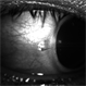 Scleral Laceration from Metallic Foreign Body Scleral Laceration from Metallic Foreign Body
