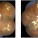 NPDR With Myelinated Nerve Fibers