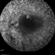 Retinitis Pigmentosa Retinitis Pigmentosa