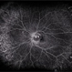 PPCNVM and Peripheral Drusen Seen on Optos FA