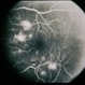 BDR / Macular Edema / Macroaneurysm BDR / Macular Edema / Macroaneurysm