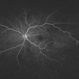 Isolated Retinal Capillary Hemangioblastoma -  Early phase IVFA