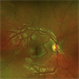 Congenital Retinal Macrovessel Congenital Retinal Macrovessel