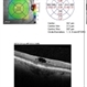 Macular Telangiectasia Type 2 OCT