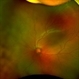 Retinopathy of Prematurity, Flying Baby Imaging Technique