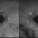 Macular Pattern Dystrophy Associated with MELAS Macular Pattern Dystrophy Associated with MELAS