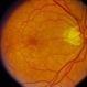 Stargardt’s Disease