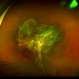 Retinal Traction Detachment Retinal Traction Detachment