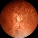 Hypertensive Retinopathy Hypertensive Retinopathy