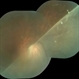 RD With Giant Retinal Tear RD With Giant Retinal Tear
