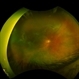 Retinal Detachment with Proliferative Vitreoretinopathy Retinal Detachment with Proliferative Vitreoretinopathy