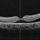 OCT in Subclinical RD in a Case of Retinitis Pigmentosa OCT in Subclinical RD in a Case of Retinitis Pigmentosa