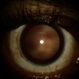 Right Eye Anterior-Segment