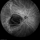 Choroidal Tumor