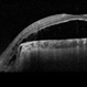Colobomatous Optic Disc Maculopathy Colobomatous Optic Disc Maculopathy