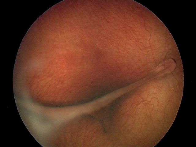 retina image retina image