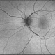 04- Unilateral Acute Idiopathic Maculopathy (UAIM) - FAF OS 04- Unilateral Acute Idiopathic Maculopathy (UAIM) - FAF OS