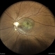 Optic Disc Pit With Macular Scar Optic Disc Pit With Macular Scar