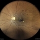 Old Vein Occlusion With Macular Edema Old Vein Occlusion With Macular Edema