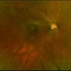 Ischemic BRVO OD Color Ischemic BRVO OD Color