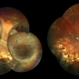 Choroid Detachment Choroid Detachment