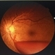 Sub Hyaloid Haemorrhage after Valsalva manoeuvre