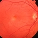 Histoplasmosis  and Subfoveal Neovascular Membrane Histoplasmosis  and Subfoveal Neovascular Membrane