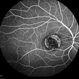 Central Areolar Choroidal Dystrophy Central Areolar Choroidal Dystrophy