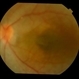 Posterior Microphthalmos