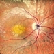 Macular Dystrophy Macular Dystrophy