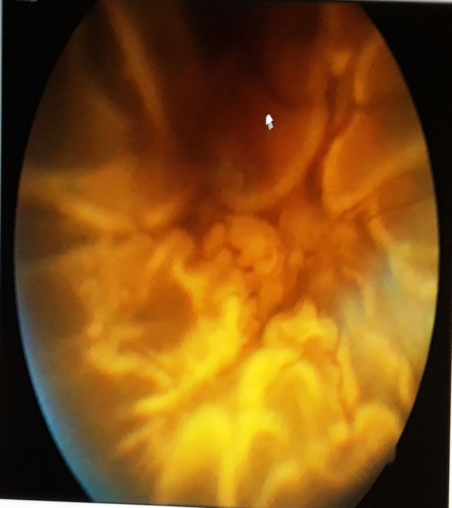 Closed Funnel Retinal Detachment - Retina Image Bank