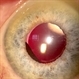 Iridociliary Cyst Iridociliary Cyst