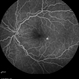 Mild Nonproliferative Diabetic Retinopathy Mild Nonproliferative Diabetic Retinopathy