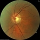 Silicon Droplet in the Cup of Optic Nerve After Multiple Intravitreal  Avastin Treatments Silicon Droplet in the Cup of Optic Nerve After Multiple Intravitreal  Avastin Treatments