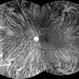 Tigroid Fundus Tigroid Fundus