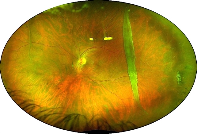 Giant retinal tear - Retina Image Bank