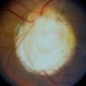 Disc Coloboma