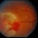 Retinal Capillary Hemangioblastoma Retinal Capillary Hemangioblastoma