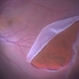 Large Retinal Tear