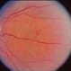 Capillary Hemangioma Capillary Hemangioma