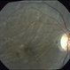 Chorioretinal Folds Orbital Tumor