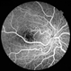 Retinal Arteriovenous Malformations (Racemose Hemangiomatosis)