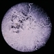 Wyburn-Mason Syndrome