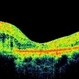 Perifoveal Telangiectasia With CNVM Perifoveal Telangiectasia With CNVM