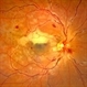 Combined Central Retinal Vein Occlusion with Branch Retinal Artery Occlusion Combined Central Retinal Vein Occlusion with Branch Retinal Artery Occlusion
