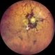 Idiopathic Intracranial Hypertension