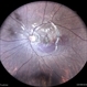 Choroidal Rupture With Traumatic Subretinal Hemorrhage